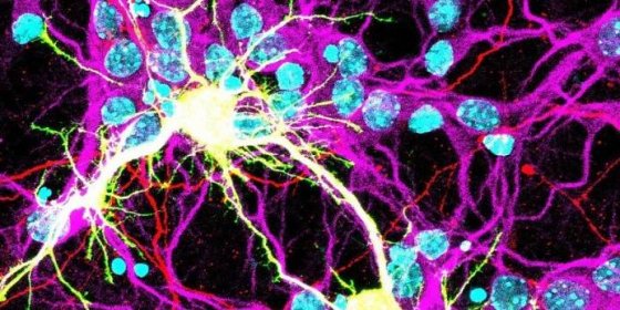 COVID-19 může v mozku vyvolávat dosud neznámou fúzi neuronů