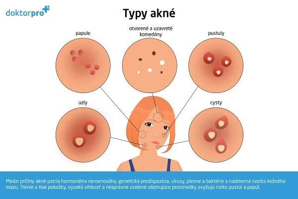 Akné: príčiny, príznaky, liečba a prevencia