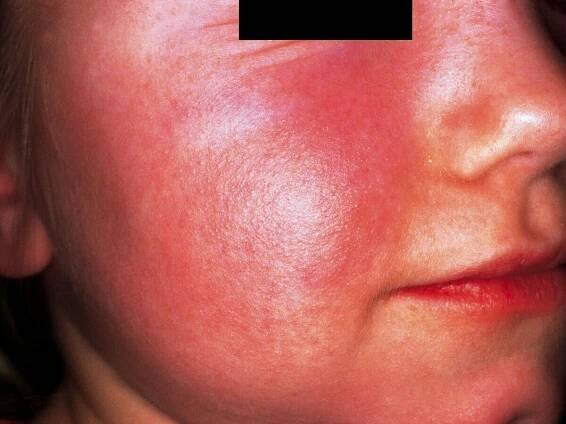 Erythema infectiosum