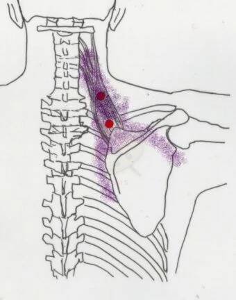 Trigger points zdvihač lopatky