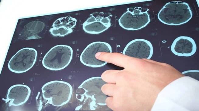skleroza_diagnoza_roztrousena_doktor_CT