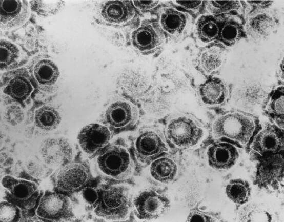 Herpes simplex virus – Wikipedie