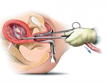 Umělé přerušení těhotenství chirurgicky | Jak miniinterupce probíhá