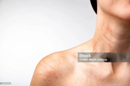 Příznaky alergie, červené vyrážky na krku a pažích. Svědění z alergenu. - Bez autorských poplatků Kopřivka Stock fotka