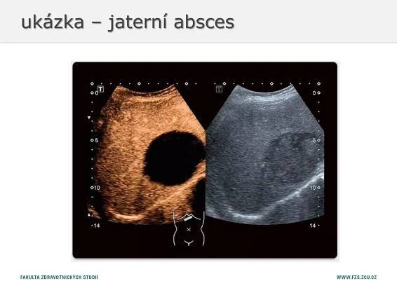 ukázka – jaterní absces
 