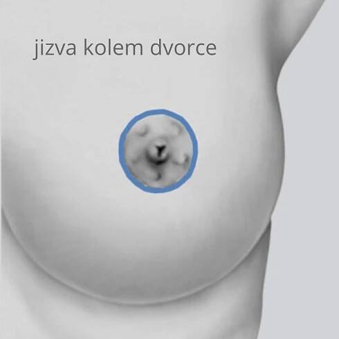 Jak vypadají jizvy po modelaci prsů?