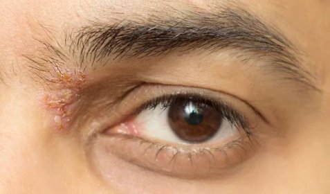 Oční alergie a pásový opar v oku