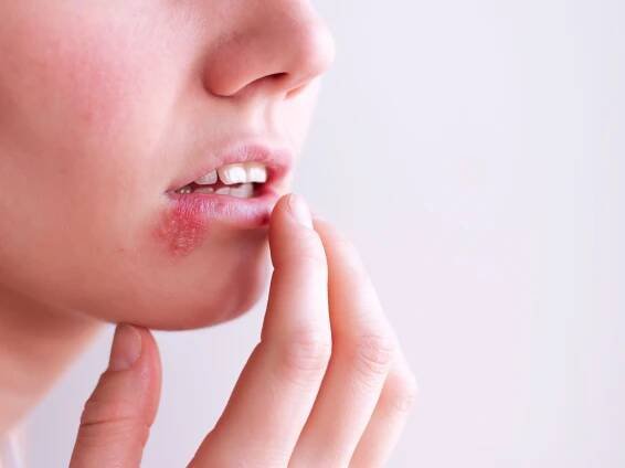 Differences Between HSV-1 and HSV-2: Oral and Genital Herpes