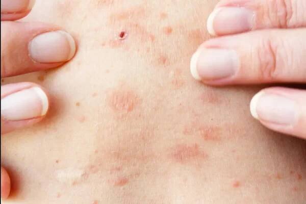 Kožní vyrážka léčba na těle ženy. pásový opar, choroba, herpes zoster, virus varicella-zoster. kožní vyrážka a puchýře na těle — Stock obrázek