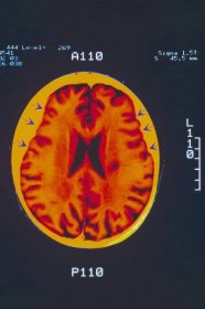 Pacientů s Alzheimerem výrazně přibude, varují lékaři! Komu hrozí nemoc nejčastěji?