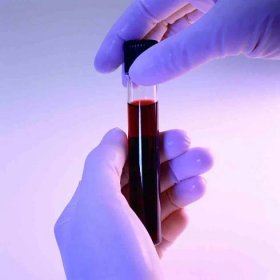 Krevní testy na spalničky, jak se mají, normy a dekódování / Krevní test