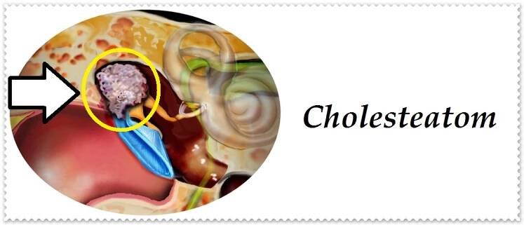 Cholesteatom zvukovodu ucha - příznaky, projevy, symptomy