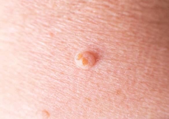 velká bradavice na kůži člověka, pozadí, makro, dermatologie - bradavicím na chodidle - stock snímky, obrázky a fotky