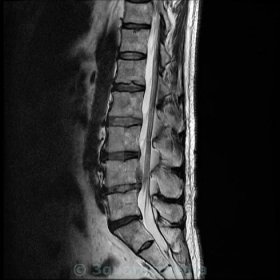 Bulging Disc Lumbar Spine MRI