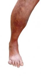 dna onemocnění na noze na bílém pozadí - erysipel vyrážka - stock snímky, obrázky a fotky