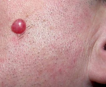 Boreliový lymfocytom je dalším kožním projevem raného stadia lymeské borreliózy. Bývá však pozorován jen asi v 5 % případů.
