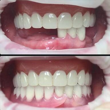 Nylonové protézy: Posouzení, cena, druhy | City Dental