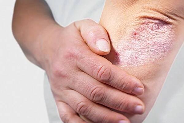 Psoriasis 101: Causes, Appearance & More