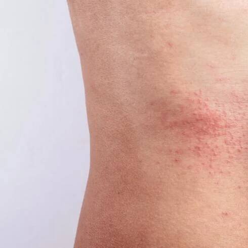 av_eczema-psoriasis_abdomen_1x1