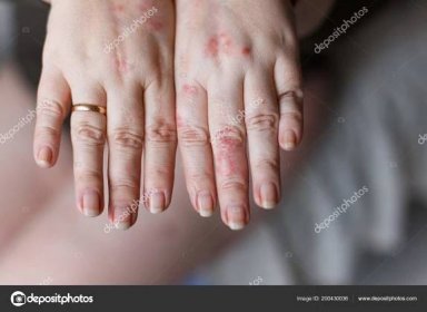 Obrázek ženských rukou jeden oteklé v důsledku vosí žihadlo. Alergií na červené skvrny na kůži. Koncepce zdraví — Stock Fotografie © ternavskaia.o@gmail.com #200430036