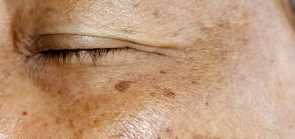 Dokonce i neškodně vypadající piha může být příznakem rakoviny kůže. Je proto doporučeno docházet s pihami na pravidelné kontroly ke kožnímu lékaři