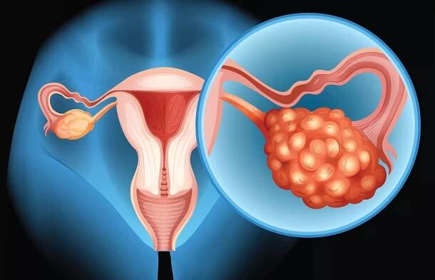 Za problémy s početím často stojí tzv. PCOS | Krasnezeny.eu