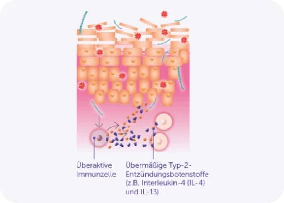 Darstellung der Hautbarriere im Falle von intakter Haut und bei Neurodermitis