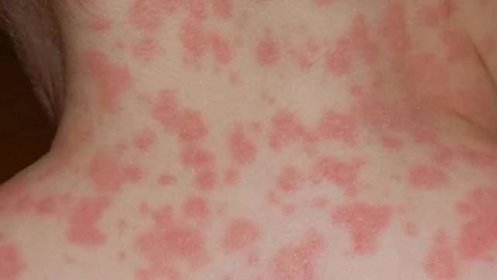 Antibiotická vyrážka – je to příznak alergie?
