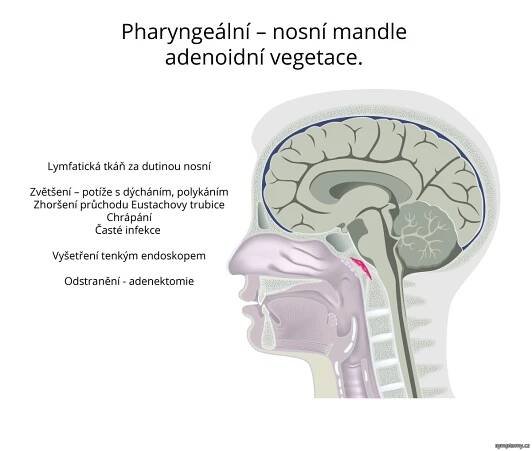 Pharyngeální (nosní mandle) adenoidní vegetace