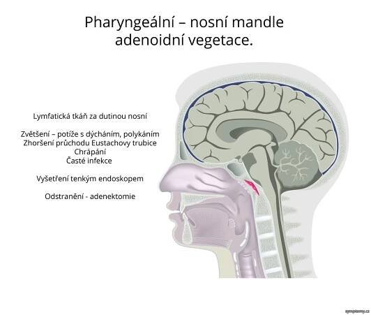 Odstranění nosních mandlí - Adenotomie - příznaky a léčba