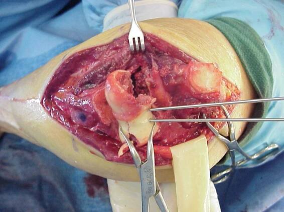 Trauma: Transcondylar distal humerus fracture repaired with Herbert screws