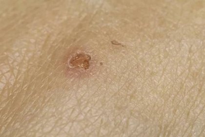 Makro kůže s kůrkou rány na kůži v důsledku infec — Stock obrázek