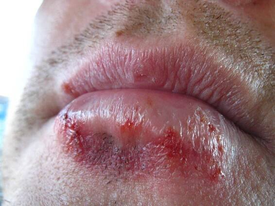 Herpes zastaví mléko i led - Zdravilek.cz - cesta ke zdraví