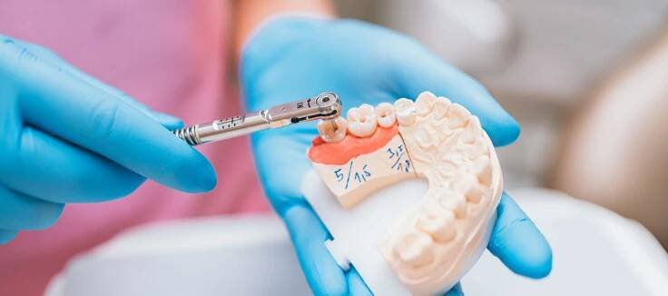 Fixní protéza na implantátech - Schill Dental Clinic