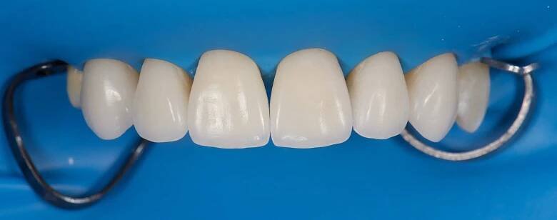 Před a po zubních zákrocích | White Dental Clinic Praha