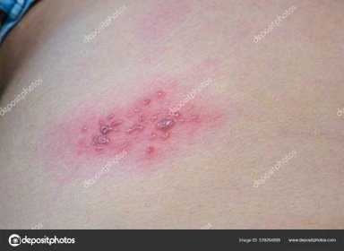 Stáhnout - Zvýšené červené hrboly a puchýře způsobené pásovým oparem na kůži, herpes zoster. — Stock obrázek