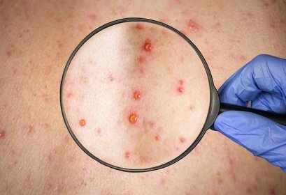 What is shingles? - NowPatient