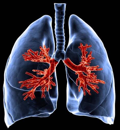 asthma