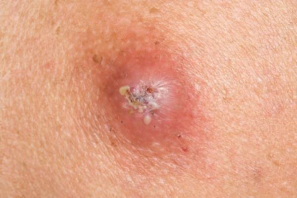 30 Facts About Cock Peculiar Tumor