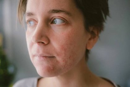 Periorální dermatitida a zprávy z fronty | Zásadně zdravě – Jana Králiková