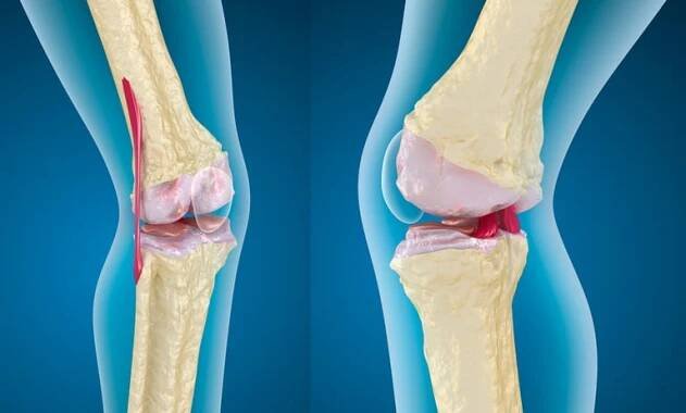 Klíčový doplněk stravy pro zdraví kostí, objevila nová studie. Pomůže s artrózou, osteoporózou i dalšími onemocněními kloubů