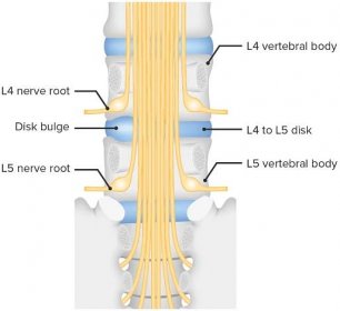 Bulging of the intervertebral disk between l4 and l5
