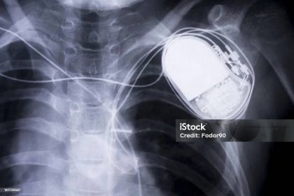 rentgenová truhla - Bez autorských poplatků Kardiostimulátor Stock fotka