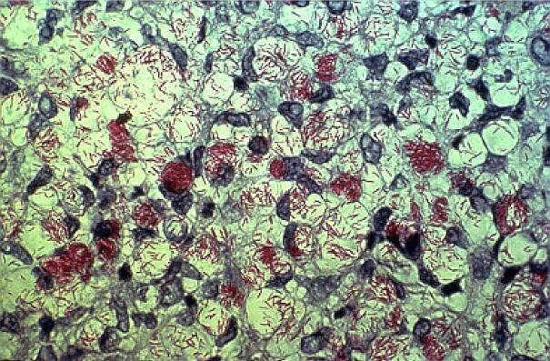 Mycobacterium leprae