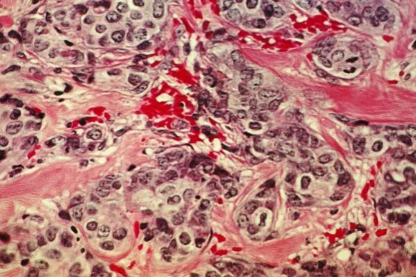 Researchers map communities of single cells in metastatic breast cancers