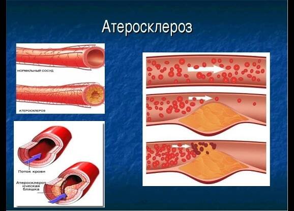 Cardiomagnet se používá k léčbě aterosklerózy
