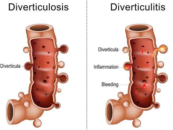 Difference between diverticulitis and diverticulosis colon illusration