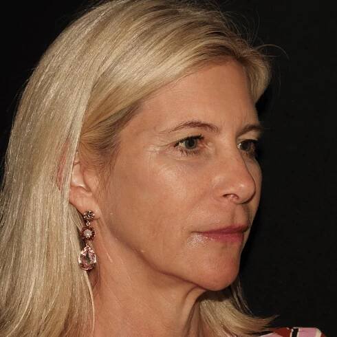 10 Emface Results 1. Non surgical facelift. BTL Aesthetics. Liquid Facelift. needle free facelift. Facial rejuvenation.