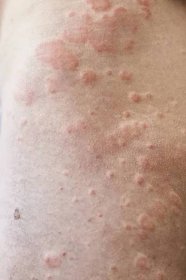 Kožní nedokonalost. Kožní alergie. Nemoc urticaria. Červené skvrny na kůži. Close-up. — Stock obrázek
