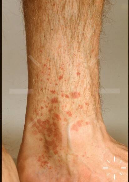 DermaCompass - Leukocytoclastic vasculitis 